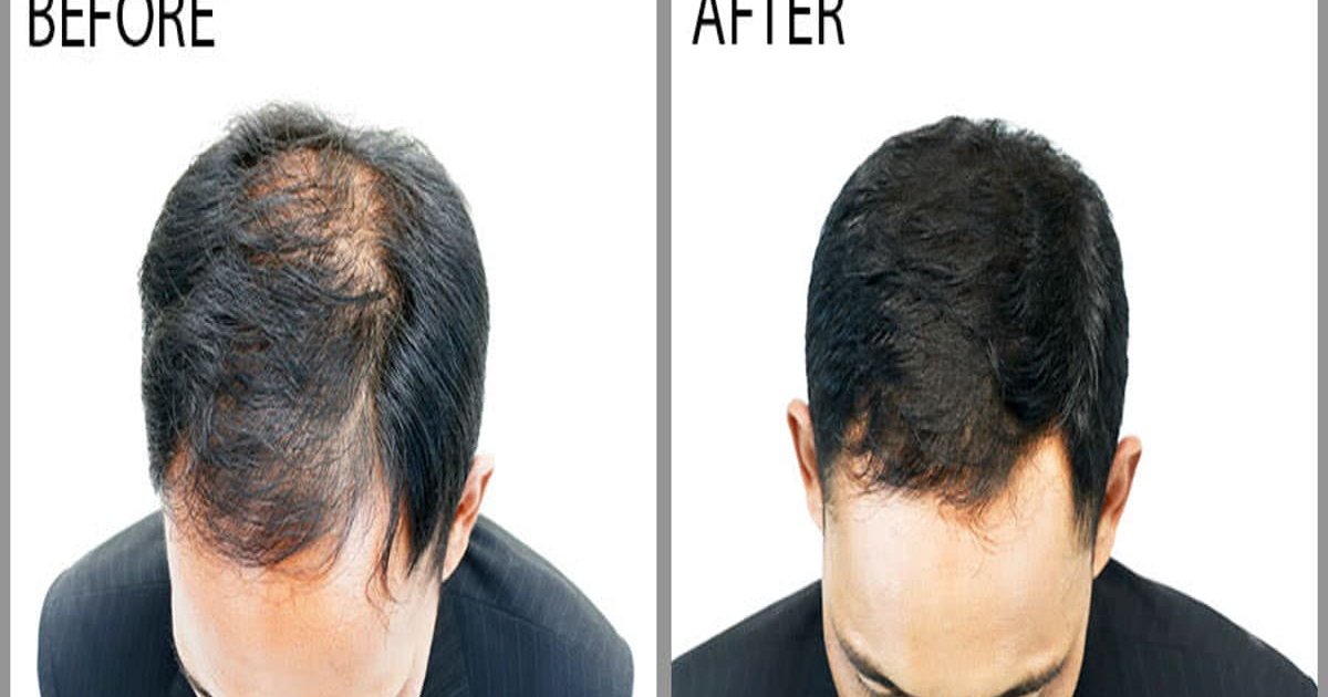 Best Hair Regrowth Treatment for Men – Restored Confidence Hair Regrowth Treatments for Men