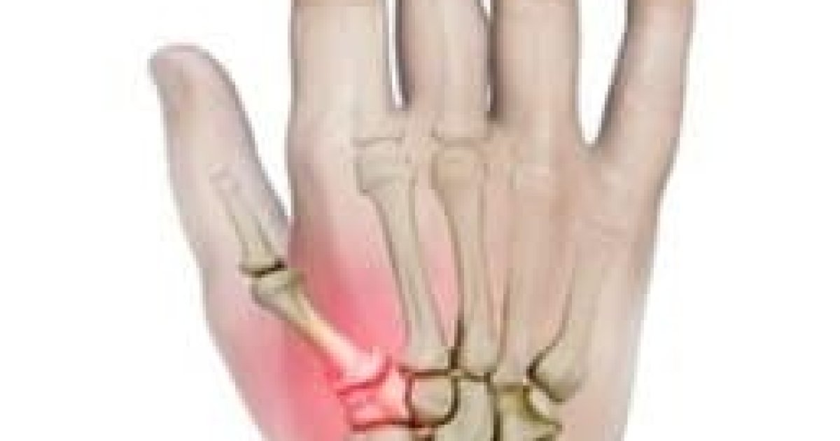 Thumb Arthritis: Understanding the 4 Stages and How to Manage It