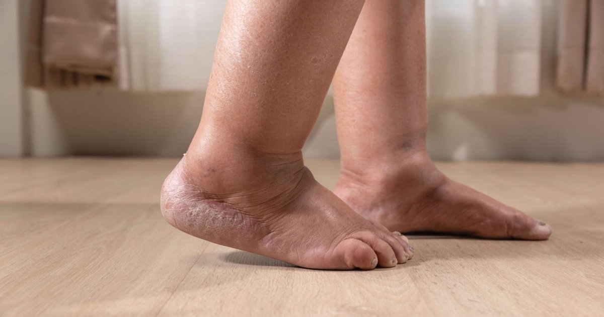 Leg Swelling in Older Adults: Causes, Prevention, and Care Tips