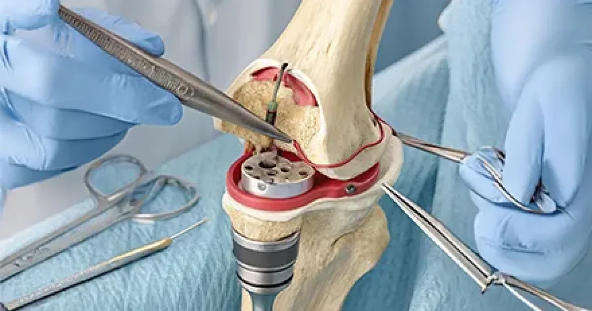 Knee Replacement Surgeons in the USA: A Guide to Finding the Right Specialist, Hospital, and Rehabilitation Program