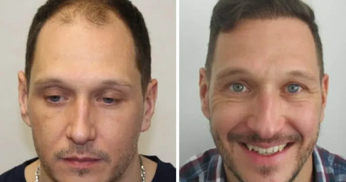 Hair Transplant in the USA: TOP 10 Clinics in 2025