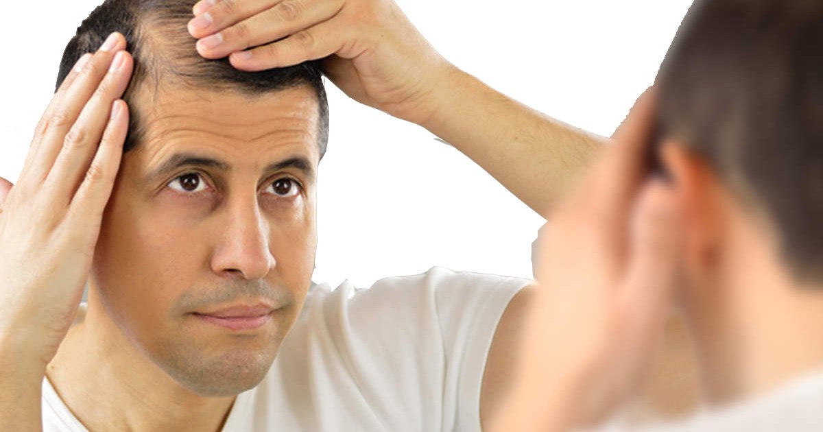 The Truth About the Best Hair Loss Treatments for Men in 2025