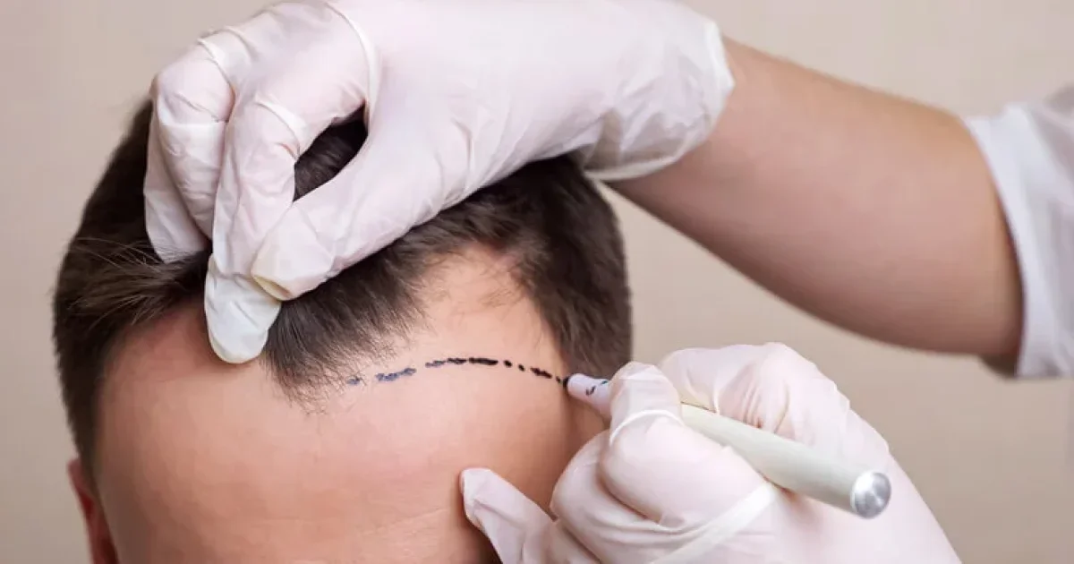 Best Hair Loss Treatment for Men: Regrowth Options That Work