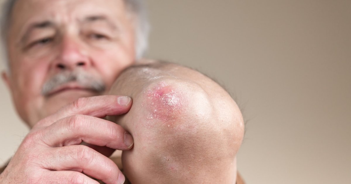 Skin Rash in the Elderly: Common Causes, Symptoms, and Care Tips