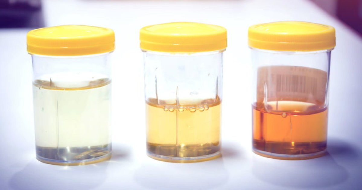 Why Is Urine Yellow?