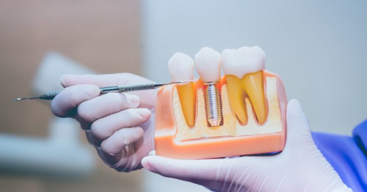 Affordable Dental Implants for Seniors & Low-Income Families: A Practical Guide to Lower-Cost Care in 2025