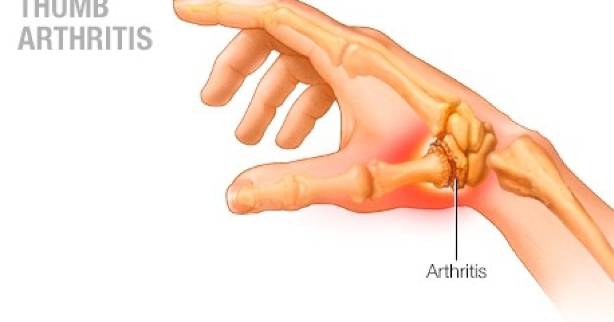 What Thumb Brace is Best for Thumb Arthritis?